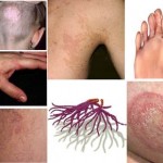 Blastomyces Mantar nedir