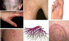 Blastomyces Mantar nedir