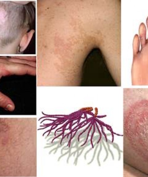 Blastomyces Mantar nedir
