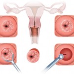 Koterizasyon Nedir?