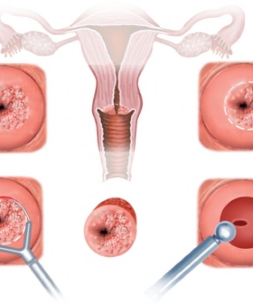 Koterizasyon Nedir?