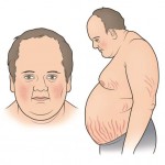 Cushing Sendromu