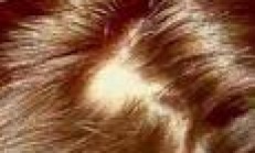 SAÇLAR SEYREKLEŞMEYE BAŞLAYINCA