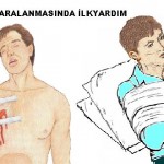 BİR YABANCI CİSMİN YADA ACIK KIRIĞIN BANTLANMASI