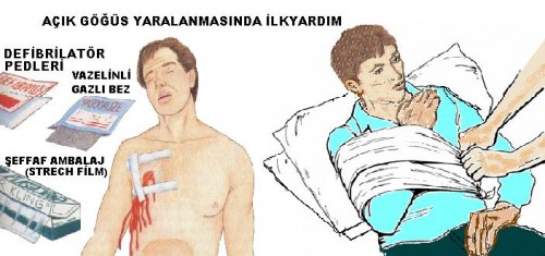 BİR YABANCI CİSMİN YADA ACIK KIRIĞIN BANTLANMASI