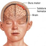 SUBDURAL HEMATOM