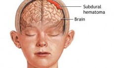 SUBDURAL HEMATOM