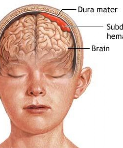 SUBDURAL HEMATOM