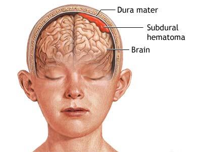 SUBDURAL HEMATOM