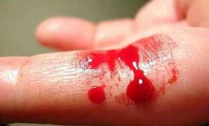 TROMBOSİTOPENİK PURPURA