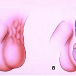 Testis İltihabı