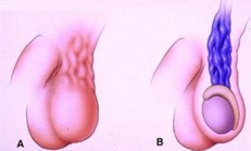 Testis İltihabı