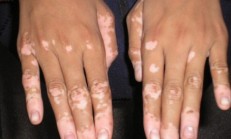 Vitiligo hastalığı