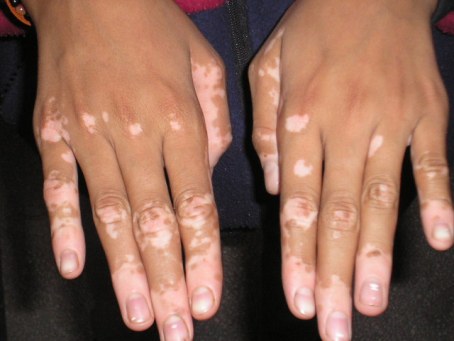 Vitiligo-hastalığı