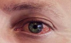 Göz Kızarıklığı Tedavisi, Şifalı Bitkiler