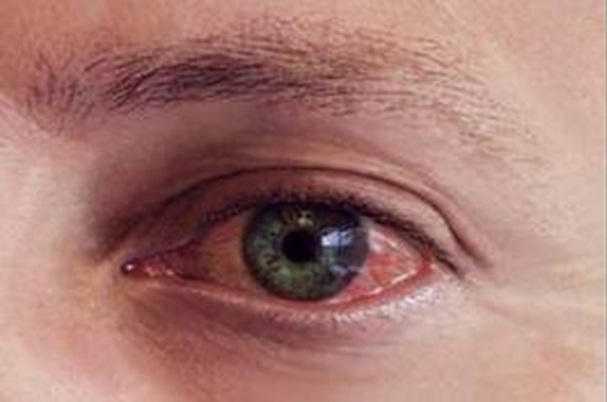 Göz Kızarıklığı Tedavisi, Göz kızarıklığı