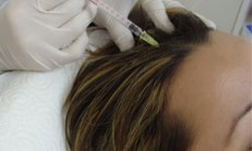 Dökülen Saça Mezoterapi