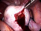 Endometriozis Nedir?