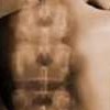 Osteoporoz Nedir?