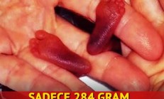 Dünyanın En Küçük Prematüre Bebeğiydi Büyüdü… İşte Şimdiki Hali