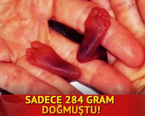 Dünyanın En Küçük Prematüre Bebeğiydi Büyüdü… İşte Şimdiki Hali