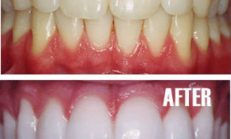 2 Dakikada Garantili Diş Beyazlatma! Sonuçlar Etkileyici