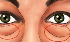 Göz Altı Torbaları ve Mor Halkalardan Kurtulmanın Doğal Yolları