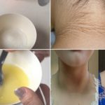 Boyun Bölgesi Kararmalarına 20 Dakikada Kesin Çözüm (Videolu)
