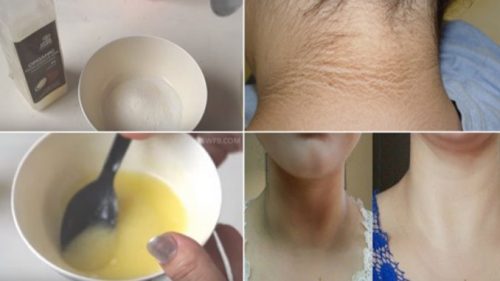 Boyun Bölgesi Kararmalarına 20 Dakikada Kesin Çözüm (Videolu)
