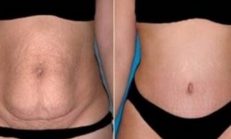 Yatarken İçeceğiniz Bu Karışımla Haftada 4 Kilo Verin (Göbek Yağı Yakma)