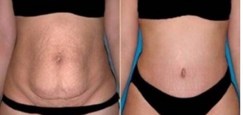 Yatarken İçeceğiniz Bu Karışımla Haftada 4 Kilo Verin (Göbek Yağı Yakma)