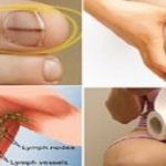 Kadınlarda Göz Ardı Edilen Kanser Belirtileri! Erken Teşhis Önemlidir