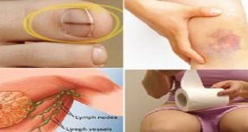 Kadınlarda Göz Ardı Edilen Kanser Belirtileri! Erken Teşhis Önemlidir