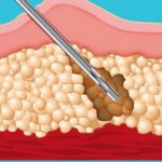 Liposuction (Yağ Aldırma) Nasıl Yapılır Eksileri Artıları Riskleri Nelerdir