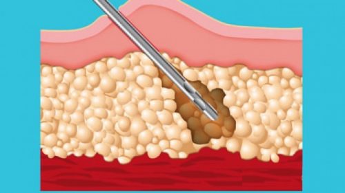 Liposuction (Yağ Aldırma) Nasıl Yapılır Eksileri Artıları Riskleri Nelerdir