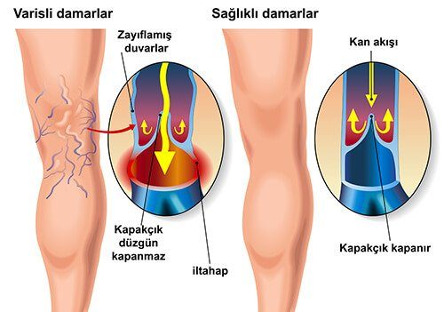 Kadınların Baş Belası Varisten Nasıl Kurtuluruz?