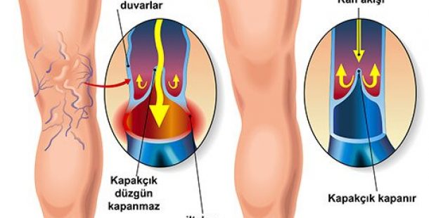 Kadınların Baş Belası Varisten Nasıl Kurtuluruz?