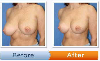 breast_red